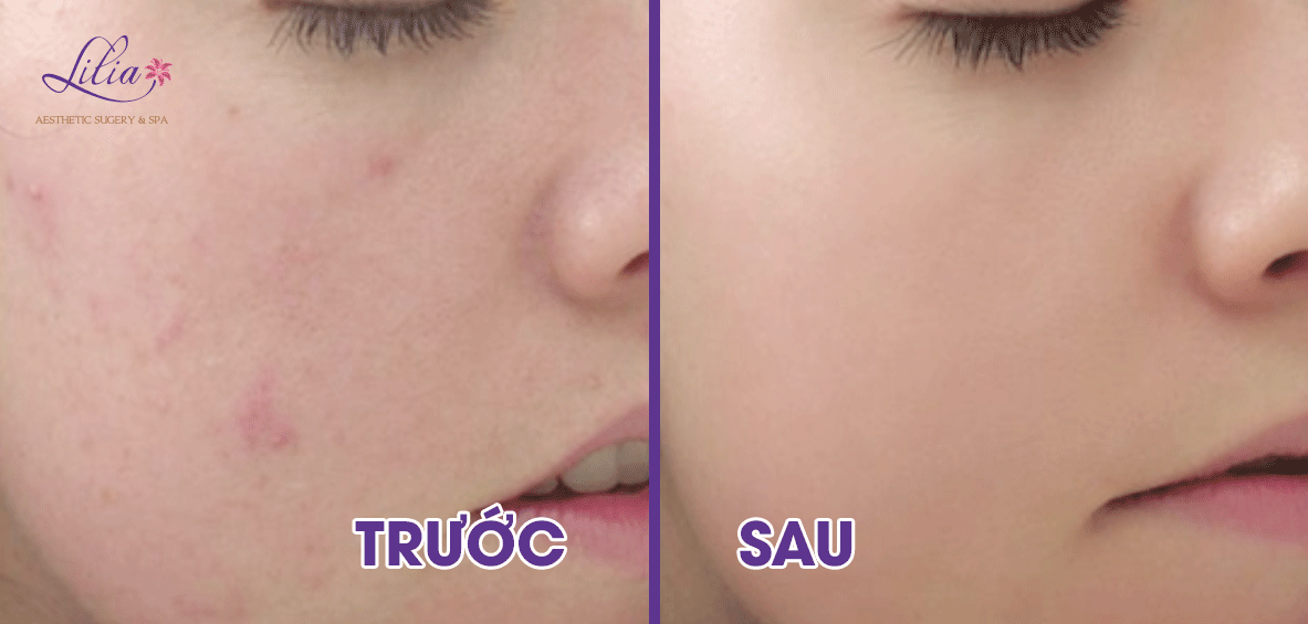 Trị mụn tận gốc